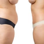 3 wichtige Fragen zur Fettabsaugung in der Schönheitschirurgie